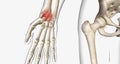 A fracture, often referred to as a broken bone, is an acute injury that causes a partial or complete break through bone