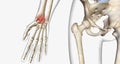 A fracture, often referred to as a broken bone, is an acute injury that causes a partial or complete break through bone
