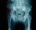 Fracture pelvis