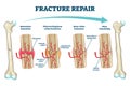 Fracture repair as educational bone remodeling formation vector illustration