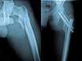 Fracture and repair of femoral bone Royalty Free Stock Photo