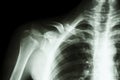 Fracture right clavicle Royalty Free Stock Photo