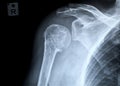 Fracture of a right human upper arm after accident
