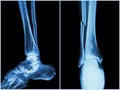 Fracture shaft of fibula bone ( leg bone ) . X-ray of leg ( 2 position : side and front view Royalty Free Stock Photo