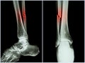 Fracture shaft of fibula bone ( leg bone ) . X-ray of leg ( 2 position : side and front view ) Royalty Free Stock Photo