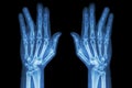 Fracture shaft of proximal phalange of ring finger ( film x-ray both hand AP ) Royalty Free Stock Photo