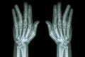 Fracture shaft of proximal phalange of ring finger ( film x-ray both hand AP ) Royalty Free Stock Photo