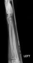 Fracture shaft of radius & ulnar bone