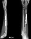 Fracture shaft of radius & ulnar bone