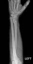 Fracture shaft of radius & ulnar bone