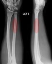 Fracture shaft of radius & ulnar bone