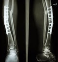 Fracture shaft of tibia and fibula Royalty Free Stock Photo