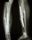 Fracture shaft of tibia and fibular (leg's bone) Royalty Free Stock Photo