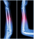 Fracture shaft of ulnar bone ( forearm bone ) : ( front and side view )