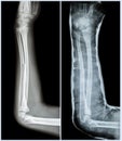 Fracture shaft of ulnar bone ( forearm bone )