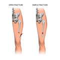 Fracture of the tibia. Two types of fracture. Vector