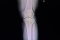 fracture tibial spine film