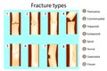 Fracture types of bones.