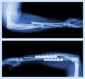 Fracture ulnar and radius (Forearm bone)
