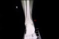 fractured lateral malleolus