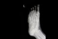 fractured metatarsal bones