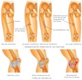 Fractures of Femur Royalty Free Stock Photo