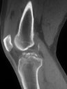 Fractures tibial spine ct scan