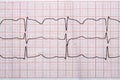 Fragment of a normal electrocardiogram with arrhythmia elements.