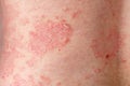 Fragment skin with chronic psoriasis vulgaris papules on male body. Genetic immune disease