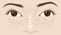 Freckle spot on caucasian woman\'s face, zoom in illustration