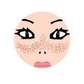 Freckles on the face. Pigmentation on the skin. A pigmented spot on the skin of the face. Vector illustration