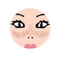 Freckles on the face. Pigmentation on the skin. A pigmented spot on the skin of the face. Vector illustration