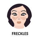 Freckles on the face. Pigmentation on the skin. A pigmented spot on the skin of the face. Vector illustration