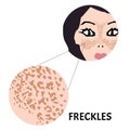 Freckles on the face. Pigmentation on the skin. A pigmented spot on the skin of the face. Vector illustration