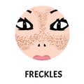 Freckles on the face. Pigmentation on the skin. A pigmented spot on the skin of the face. Vector illustration