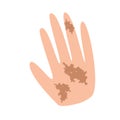 Freckles on the hand. Pigmentation on the skin. A pigmented spot on the skin of the hand. Vector illustration