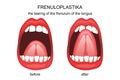 Frenuloplastika. the tearing of the frenulum of the tongue