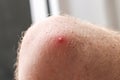 Fresh ripe pimple on a man elbow. Unhealthy skin