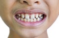 Front teeth gaps Royalty Free Stock Photo