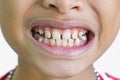 Front teeth gaps Royalty Free Stock Photo