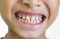Front teeth gaps Royalty Free Stock Photo
