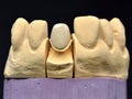 Front teeth implant