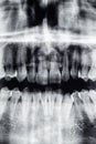 Dental X-Ray of front teeth and nose Royalty Free Stock Photo