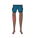 Front view of a bruised dark skin leg illustration