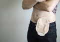 Front view on colostomy bag attached to man patient, medical theme. Skin color ostomy pouch close-up. Colon cancer surgery