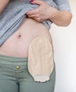 Front view on colostomy pouch in skin color attached to woman patient. Close-up on ostomy bag after surgery