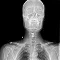 Front X-RAY IMAGE of cervical spondylosis Royalty Free Stock Photo