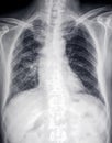 Lung diseaseÃ¯Â¼Å¡front X-ray image of heart and ches Royalty Free Stock Photo