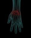 Front x-ray view of human painful hand Royalty Free Stock Photo