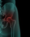 Front x-ray view of human painful hip